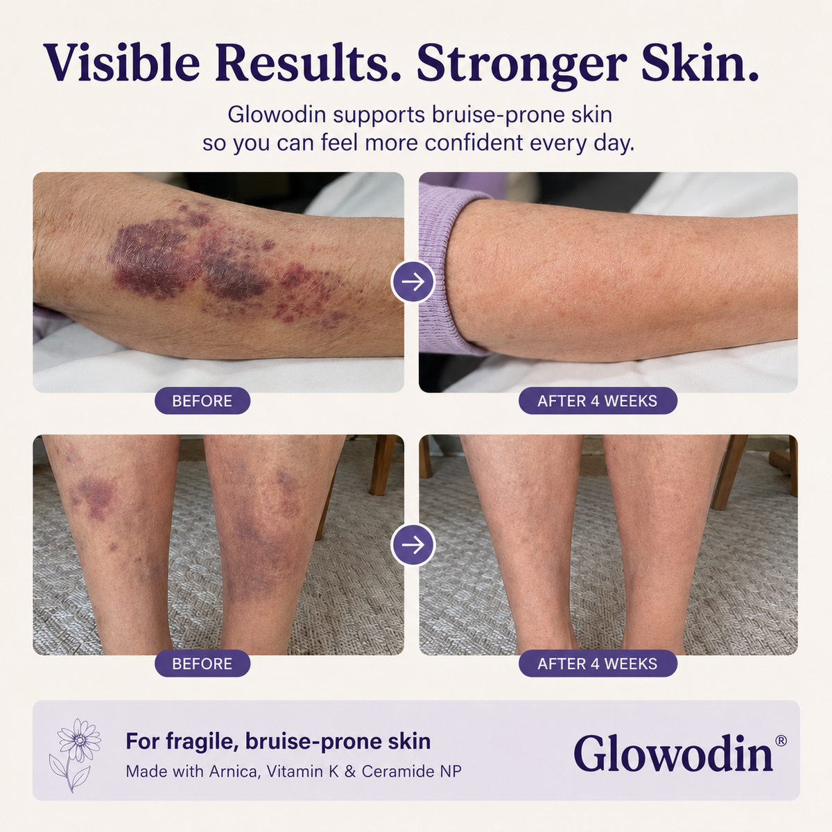 Fade the Look of Bruises on Thin, Aging Skin