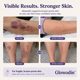Fade the Look of Bruises on Thin, Aging Skin