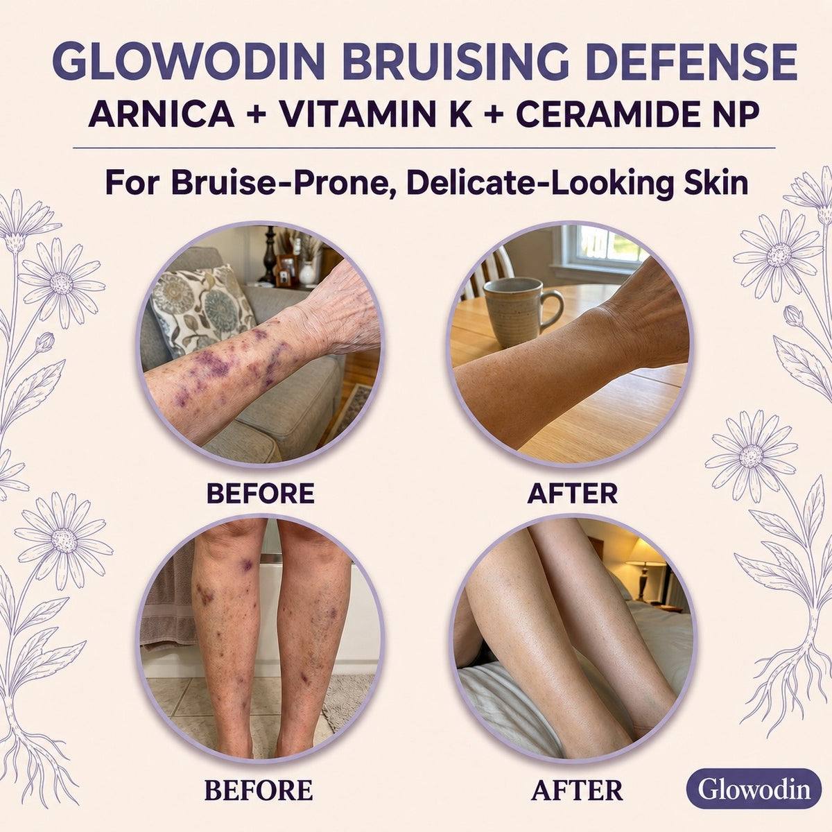 Fade the Look of Bruises on Thin, Aging Skin