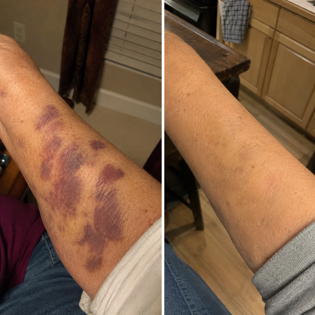 Fade the Look of Bruises on Thin, Aging Skin